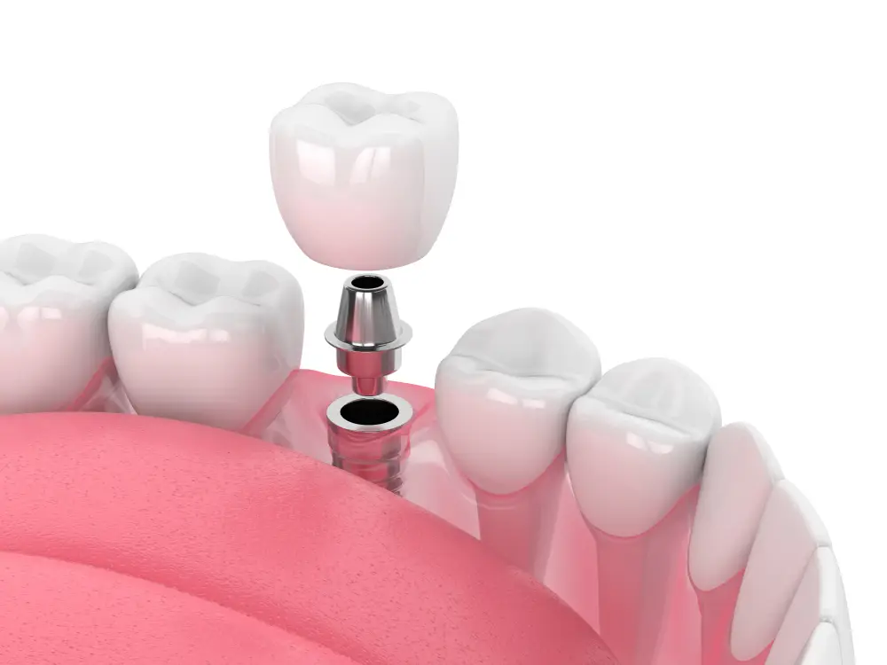 detailed image of a dental implant
