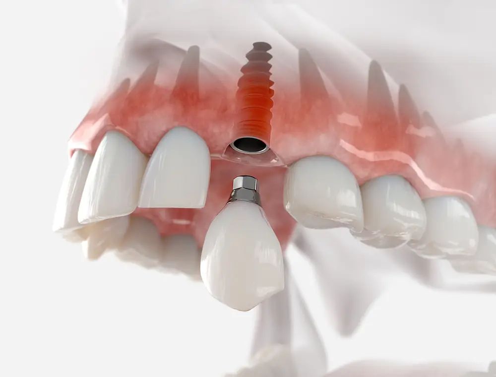 informative graphic of tooth implant