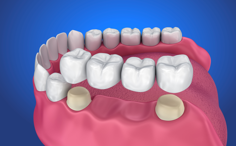 dental crowns Southport